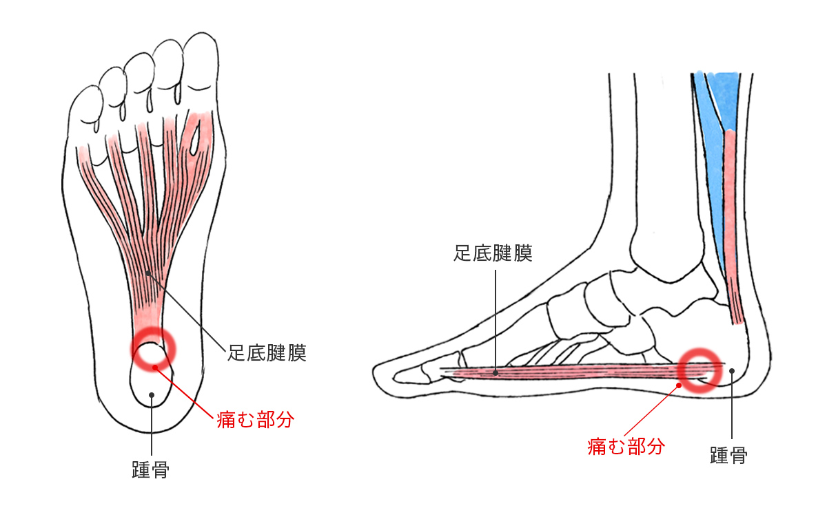 足の裏に痛みが生じる部分の図