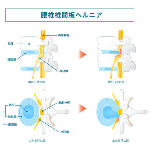 腰椎椎間板ヘルニア