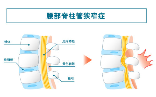 腰部脊柱管狭窄症