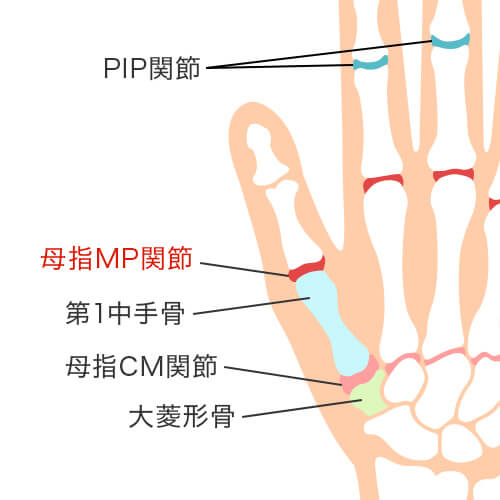 ばね指（弾発指・屈筋腱腱鞘炎）