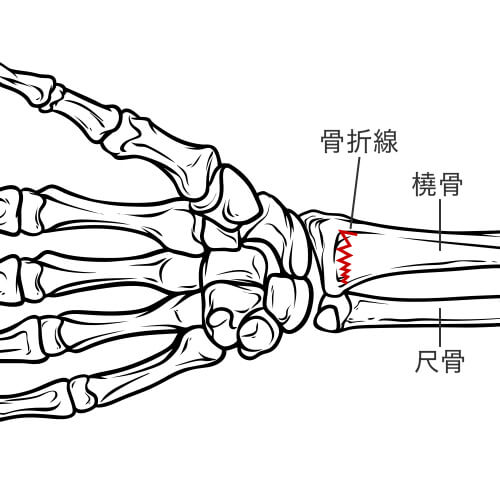 橈骨遠位端骨折