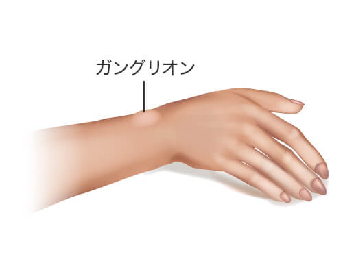ガングリオン